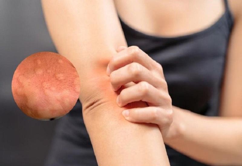 Bị Ngứa Da Vào Ban Đêm Là Bệnh Gì? Nguyên Nhân Và Cách Khắc Phục
